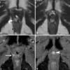 Screenbrag from “Biochemical Recurrence Post-radical Prostatectomy”