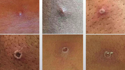 Monkeypox sores