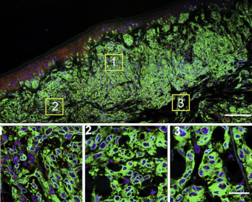 Possible Culprit for Sex Differences in Melanoma Treatment Response