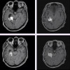MRI scans of two people with BRAF-positive brain tumors treated with dabrafenib and trametinib (patient 1 - top row, patient 2 - bottom row), showing initial tumor shrinkage and subsequent regrowth