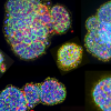 Immunofluorescence image of micro-organospheres created from a human lung tumor, showing tumor cells (yellow and green) and T cells (red).