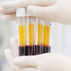 Blood separated into plasma (yellow) and red blood cells