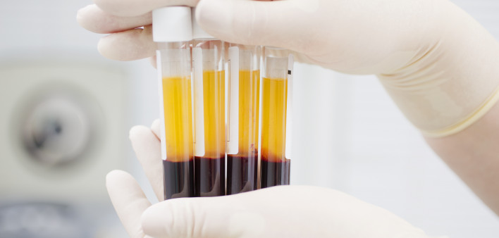 Preparing blood for Plasmolifting.