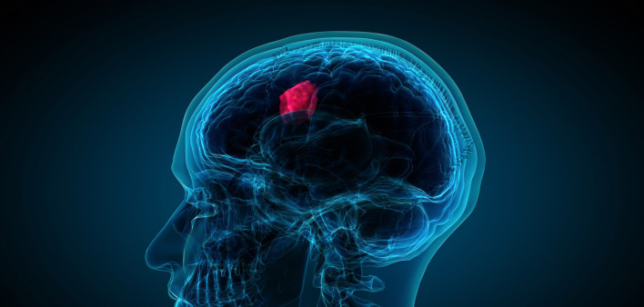 x-ray of brain showing tumor.