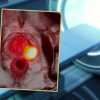Left: MRI only. Right: PSMA/PET MRI fused image clearly shows prostate cancer.