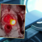 The Prostate Specific Membrane Antigen (PSMA) PET Scan