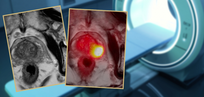 The Prostate Specific Membrane Antigen (PSMA) PET Scan