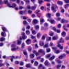 Myeloma cells (purple) in a patient's bone marrow, with a few normal cells in pink in the background.