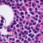 Fred Hutchison, multiple myeloma, bone marrow