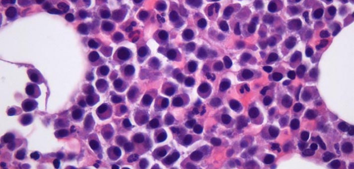 Fred Hutchison, multiple myeloma, bone marrow
