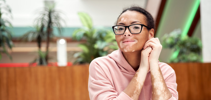 Black african american woman with vitiligo pigmentation skin problem