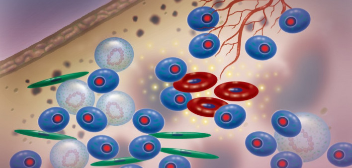 multiple myeloma