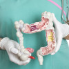 Colon cancer