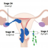 Stage 3 endometrial cancer