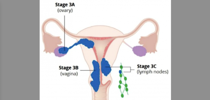 endometrial cancer, stage 3, and immunotherapy