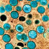 Monkeypox virus