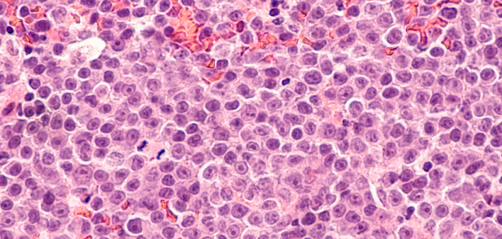 Diffuse Large B-cell Lymphoma  Lymphoma, Myeloma, Leukemia, Lymphocyte, Tumor