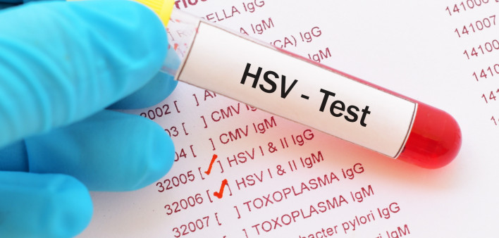 Herpes simplex virus (HSV) test  Analyzing, Biology, Blister, Blood, Blood Test