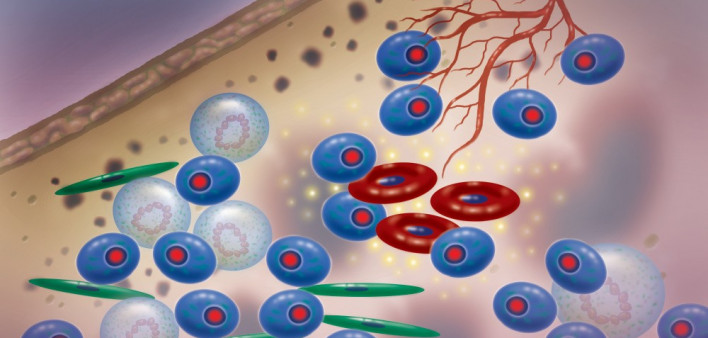 multiple myeloma