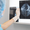 Mammogram image