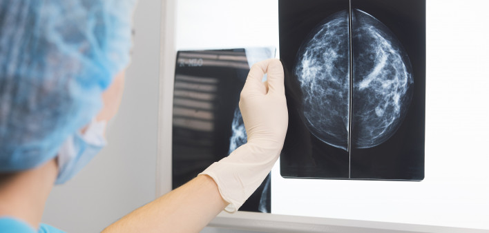 Mammogram image