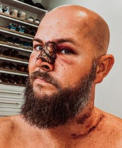 Melanoma Research Alliance  skin cancer Andrew Smith