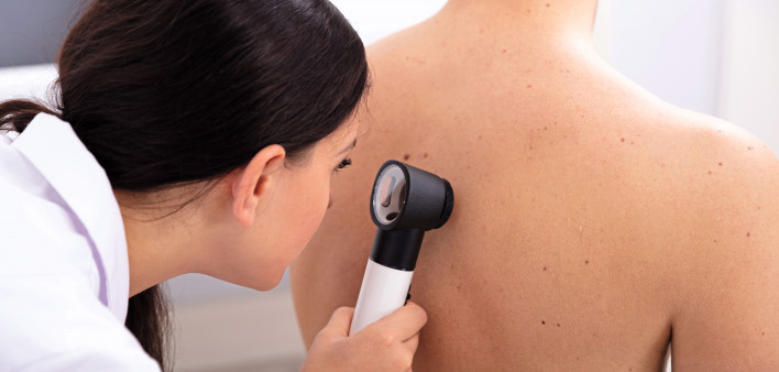 doctor looking for skin cancer melanoma