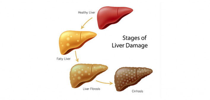 fatty liver disease, NAFLD, NASH, cirrhosis