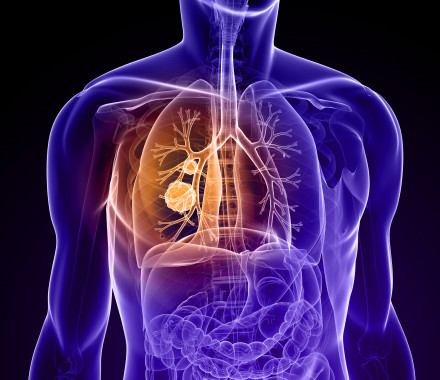 Diagram of a torso showing site of cancer in the lung