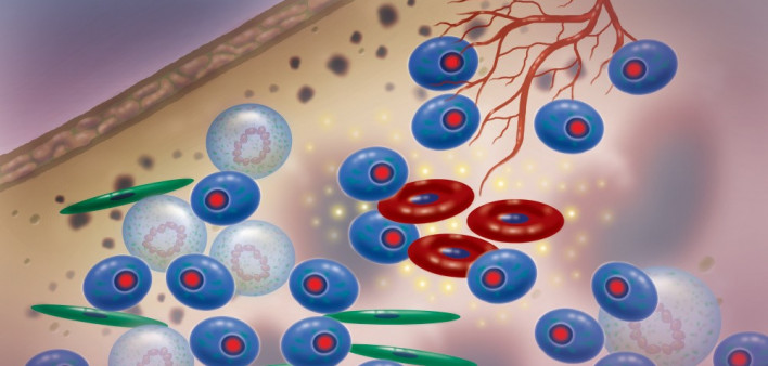 multiple myeloma