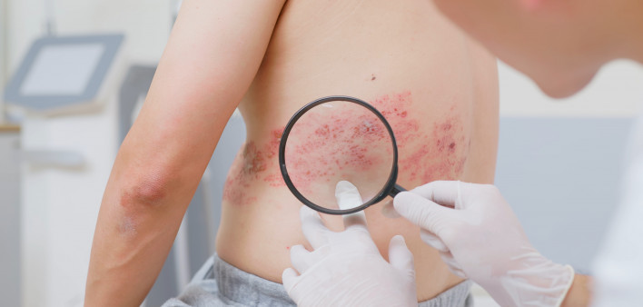 Doctor examine shingles disease