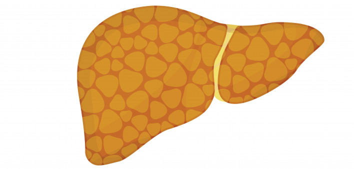liver steatosis