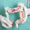 Colon cancer