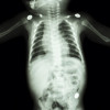 x-ray of child showing bones