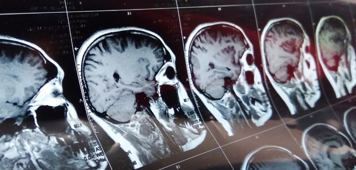 Magnetic resonance scan of the brain with skull.