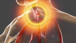Esophageal cancer, 3D illustration showing malignant tumor in the human esophagus