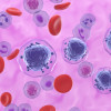 Acute myeloid leukemia (AML) cells, shown in purple, floating among other cells. AML is a type of blood cancer that starts in your bone marrow.