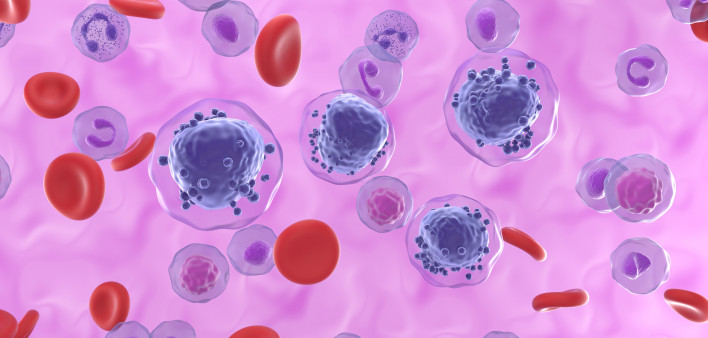 Acute myeloid leukemia AML blood cancer