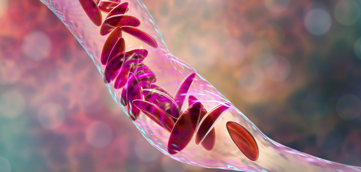Sickle cell anemia