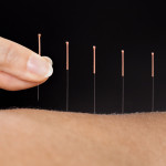 fingers with acupuncture needles in arm