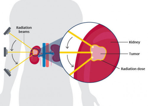 SBRT kidney cancer treatment NCI