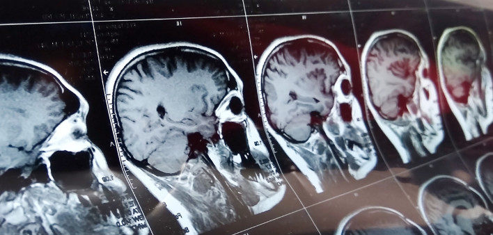 Magnetic resonance scan of the brain with skull.