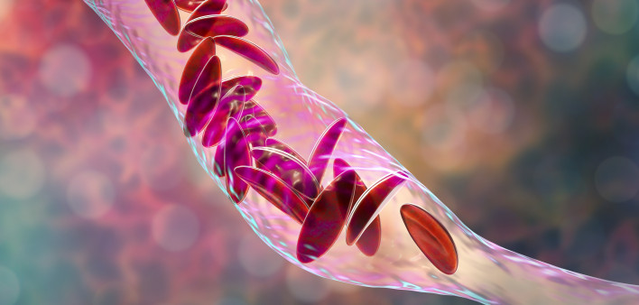 Sickle cell anemia