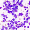 Multiple myeloma