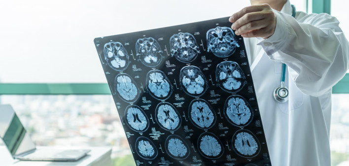 doctor looking at mri of brain