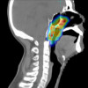 Imaging scans of a person with a nasopharyngeal carcinoma that has come back (recurrent)