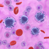 Acute myeloid leukemia (AML) cells, shown in purple, floating among other cells. AML is a type of blood cancer that starts in your bone marrow.