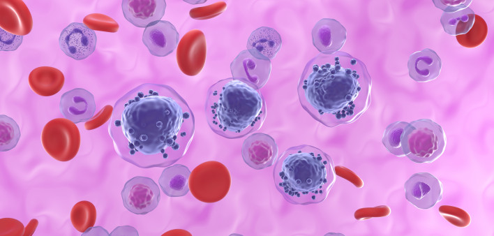 Acute myeloid leukemia AML blood cancer