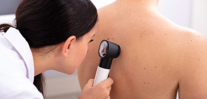 doctor looking for skin cancer melanoma