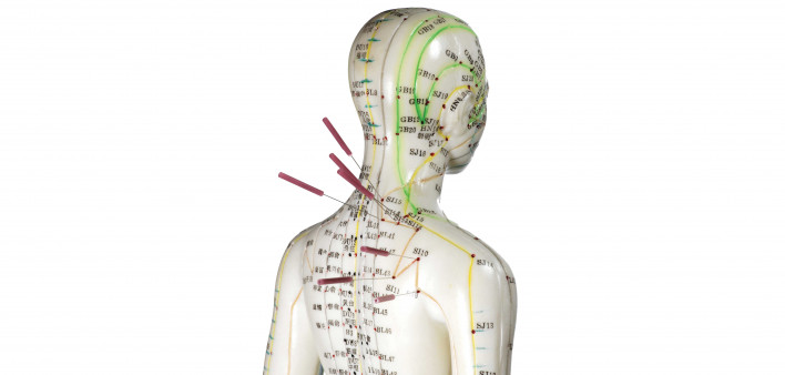 Female acupuncture model with needles in the shoulder